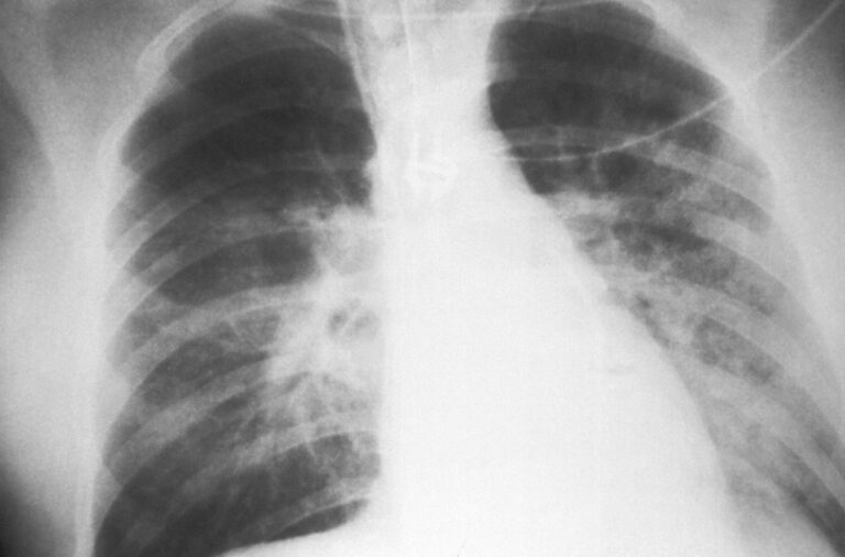 Chest x-ray showing bilateral infiltrates and cardiomegaly.